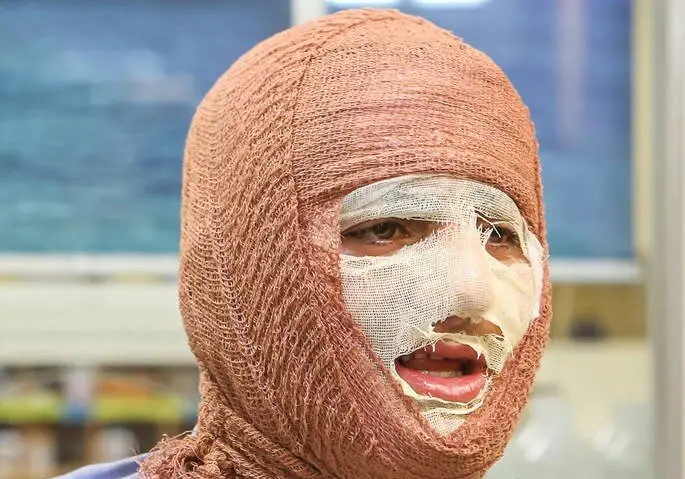 از کمبود تخت تا هزینه‌های سنگین درمان؛ روایت سوختگی در ایران