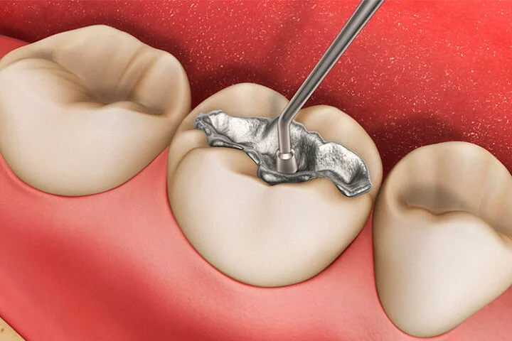 پرکردن دندان با آمالگام؛ از مزایا تا معایب آن