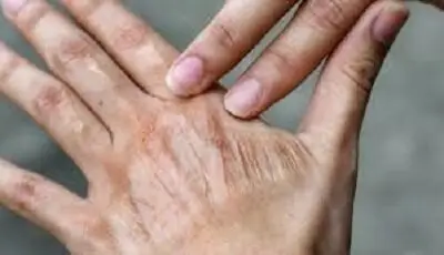 آلودگی هوا چگونه پوست شما را پیرتر و آسیب‌پذیرتر می‌کند؟