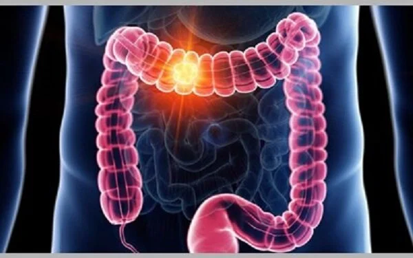 بومی‌سازی روش تشخیص زودهنگام سرطان روده بزرگ با استفاده از دی‌ان‌اِی مدفوع