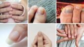 ۷ نشانه هشداردهنده کلسترول بالا که ناخن‌هایتان فریاد می‌زنند!