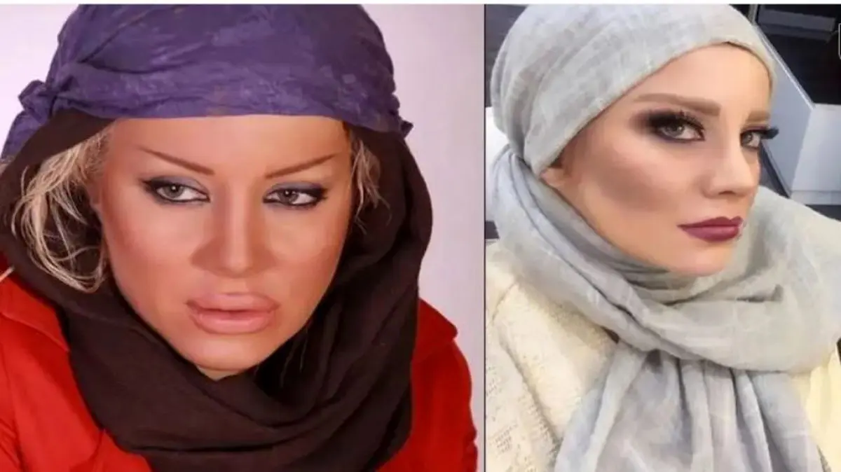 اعتراف تکان‌دهنده شراره رخام: چگونه تزریق ژل لب بازیگری‌ام را نابود کرد؟