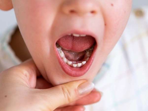 دلایل تاخیر در رویش دندان دائمی