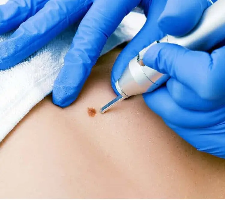 کرایوتراپی (انجماد)