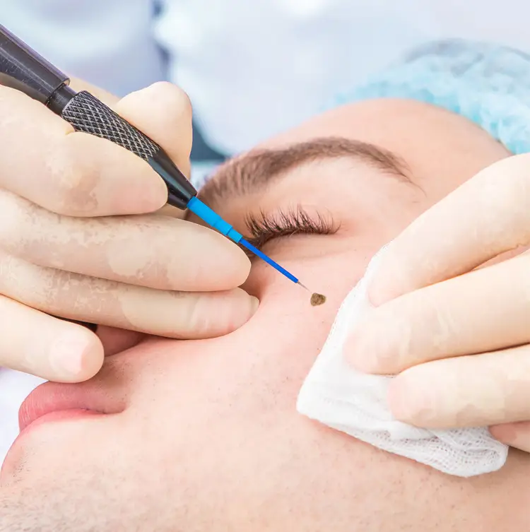 چه زمانی باید در مورد یک خال گوشتی، نگران بود؟