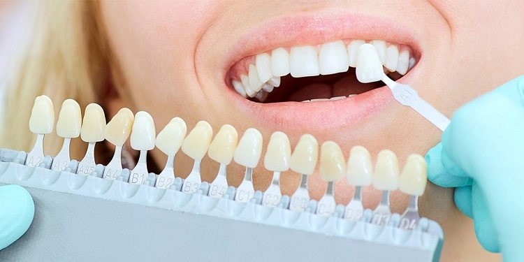 عوامل مؤثر بر قیمت کامپوزیت دندان 