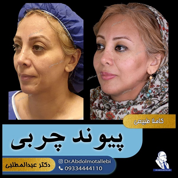 بهترین متخصص تزریق چربی به صورت در تهران کیست؟