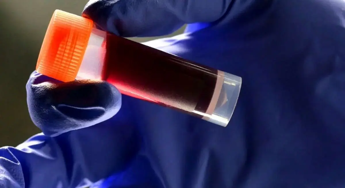 کدام گروه خونی بیشترین خطر سکته مغزی زودرس را دارد؟ کشف جدید دانشمندان