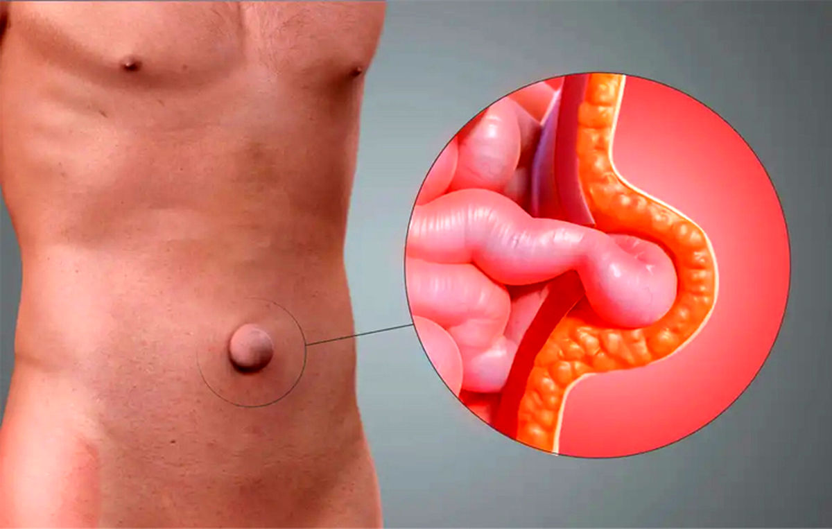 درمان فتق شکمی بدون بیهوشی؛ آیا راه‌های جدیدی وجود دارد؟