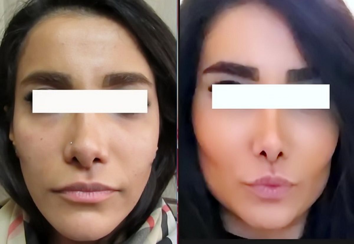 زاویه سازی فک؛ راهی نوین برای زیبایی بی‌نقص یا ریسک‌های پنهان؟