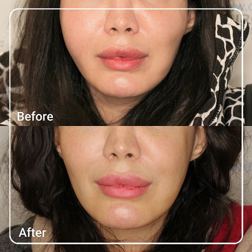 زاویه سازی صورت و فک | قبل و بعد