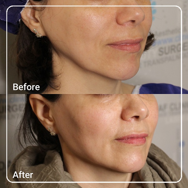 زاویه سازی صورت و فک 