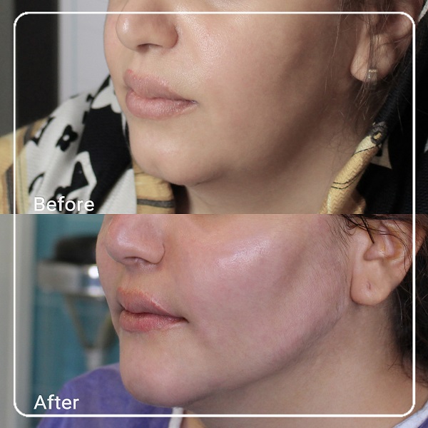 نمونه قبل و بعد از زاویه‌سازی صورت با تزریق فیلر