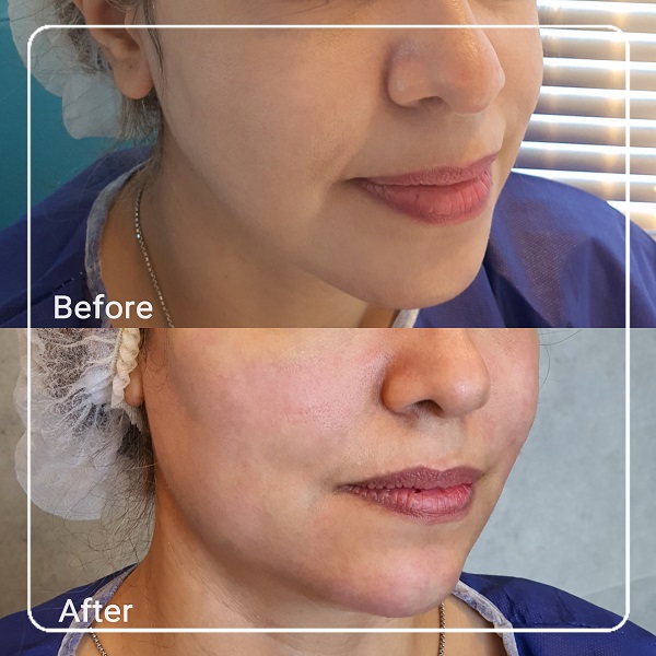 زاویه سازی صورت و فک | روش ها، مزایا، معایب و هزینه‌ها