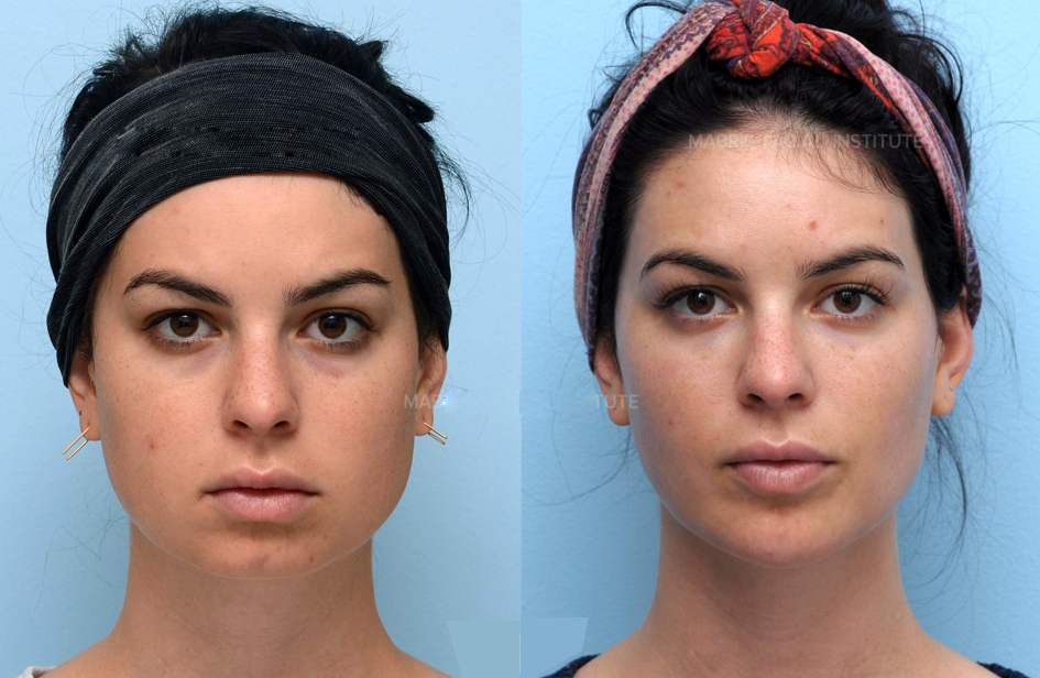 زاویه سازی فک در چهره متناسب