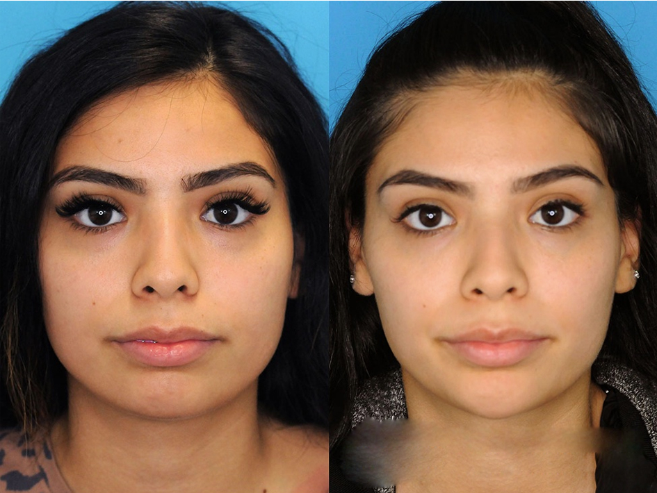 زاویه سازی فک در صورت‌های پهن