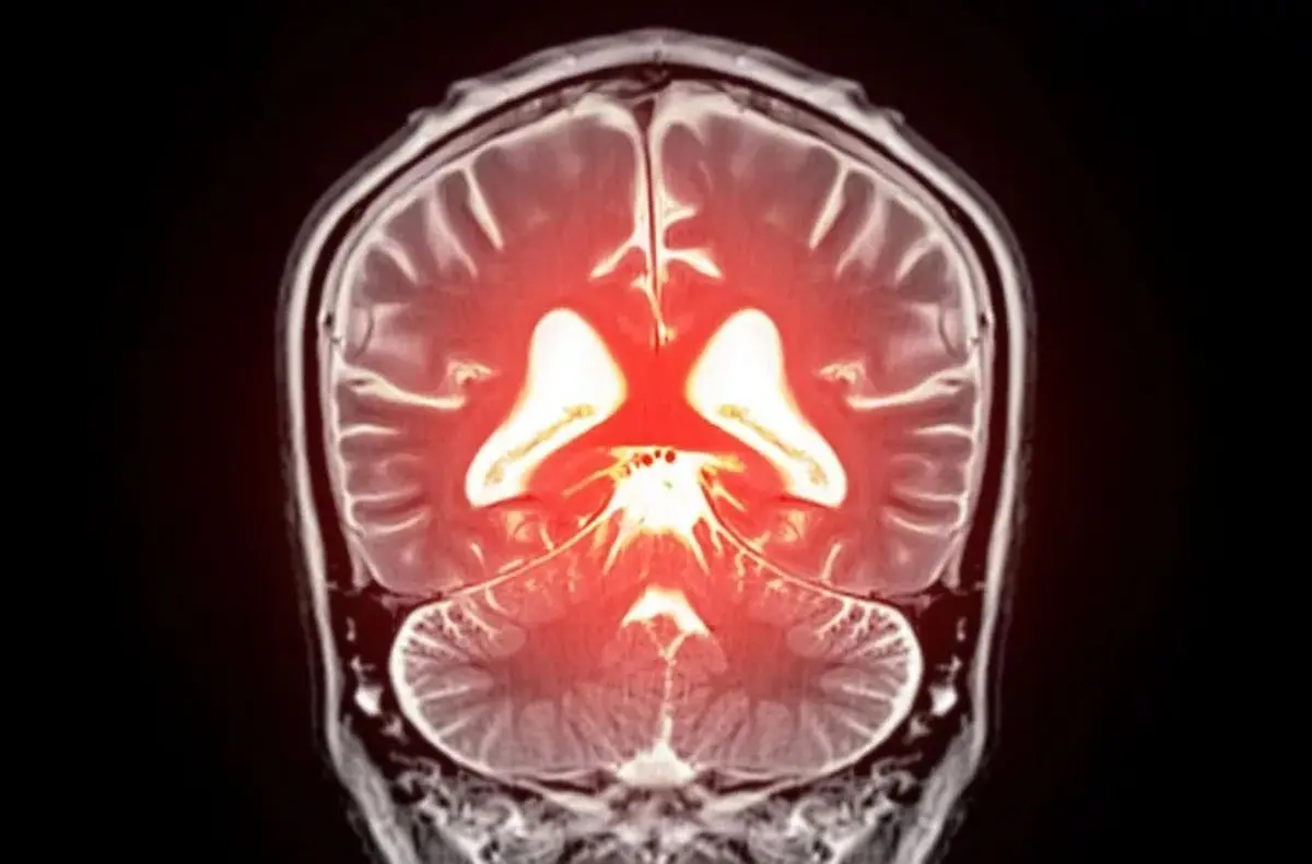 کشفی نوین: چگونه کنترل یک پروتئین کلیدی می‌تواند زوال عقل را متوقف کند؟