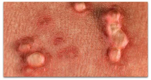 زگیل-تناسلی