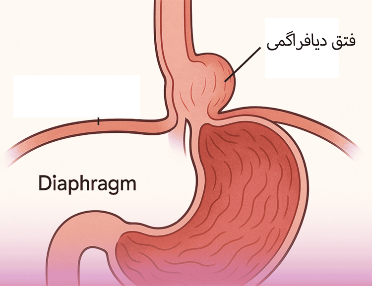 فتق دیافراگمی