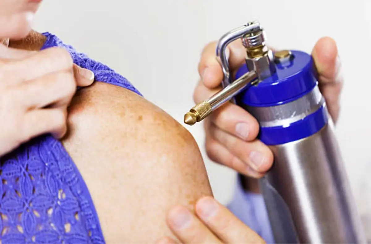 فریز کردن خال گوشتی؛ راهی نوین و بی‌دردسر برای حذف ضایعات پوستی!