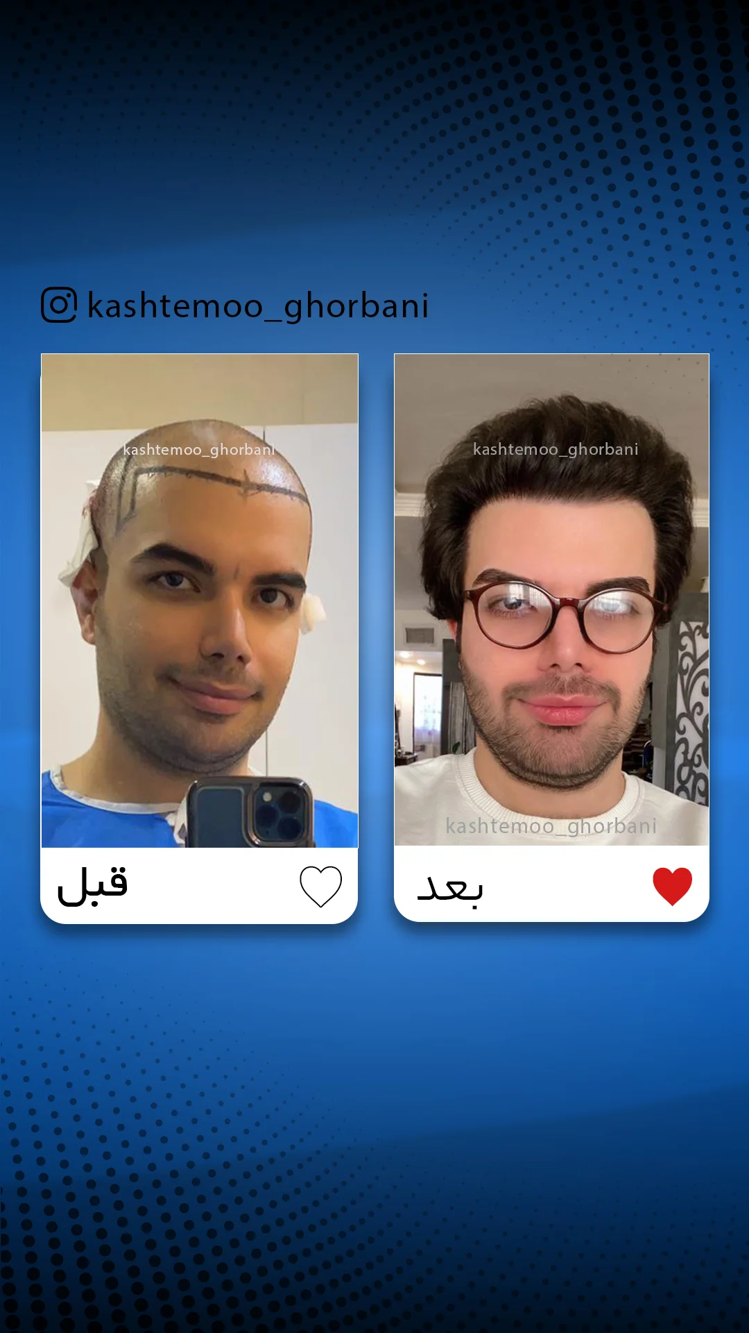 کلینیک کاشت مو مریم قربانی