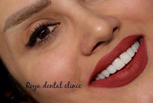 کامپوزیت دندان چیست؟