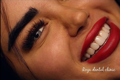 تفاوت کامپوزیت با لمینت‌های سرامیکی