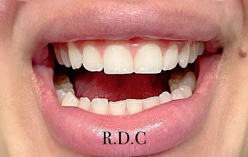 عوارض ترمیم با کامپوزیت