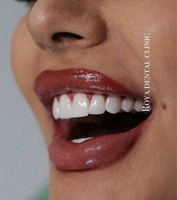 عوارض ترمیم با کامپوزیت