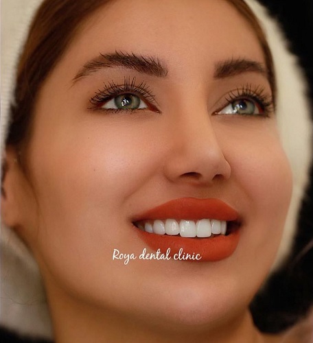 اصلاح طرح لبخند با کامپوزیت چگونه است؟