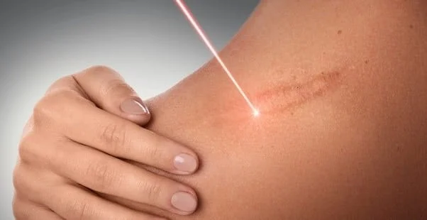 نقش سلول های بنیادی در زخم ها