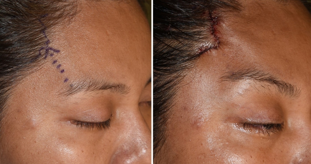 لیفت شقیقه چگونه انجام می شود؟