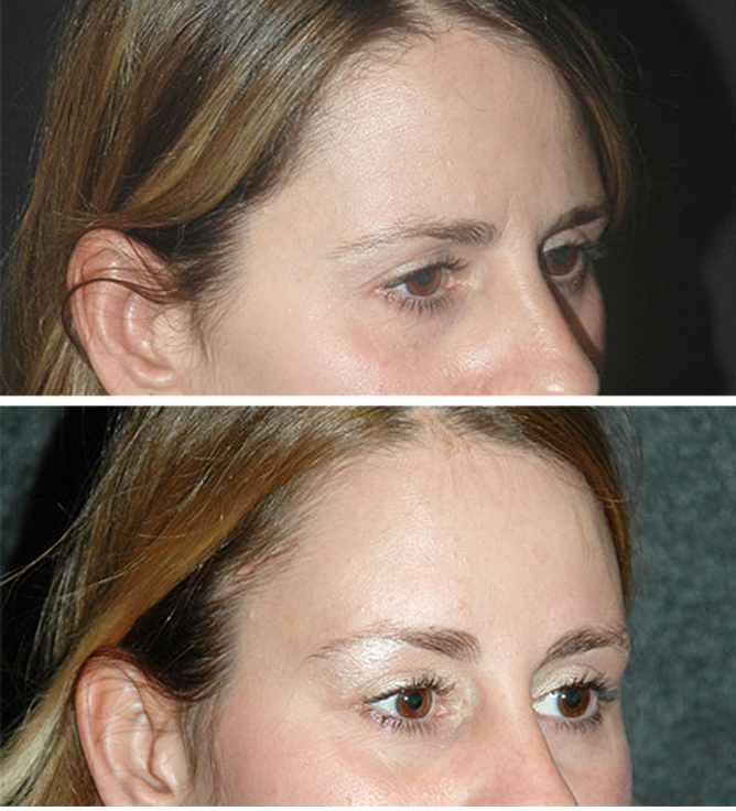 بهترین زمان برای انجام لیفت شقیقه چه زمانی است؟