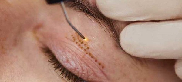 لیفت شقیقه با پلاسما