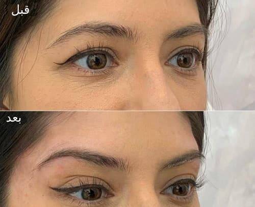 لیفت شقیقه با ژل