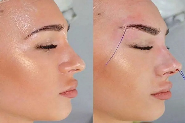 لیفت شقیقه با نخ