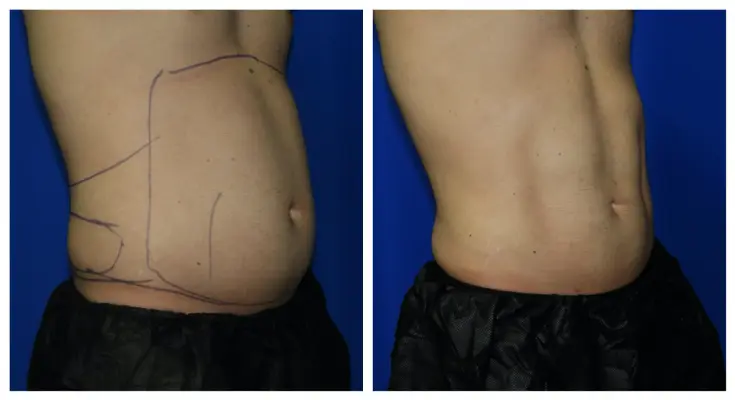 بهترین روش لاغری بدون جراحی کدام است؟ - بررسی 16 روش