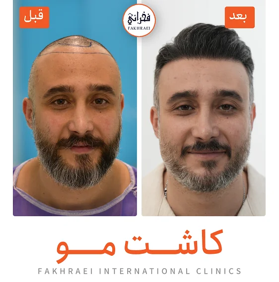 نمونه+کاشت+مو+-+کلینیک+فخرایی