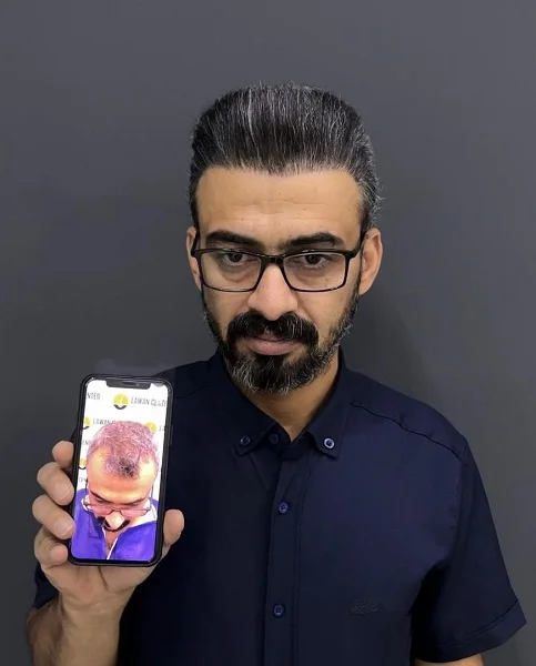 نمونه کاشت مو - کلینیک پارسیان بیوتی