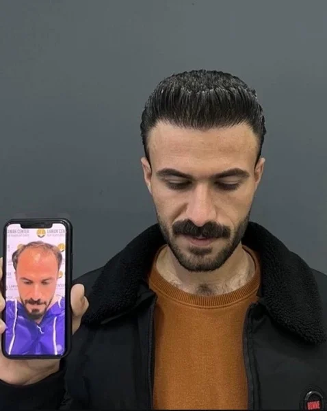 نمونه کاشت مو - کلینیک پارسیان