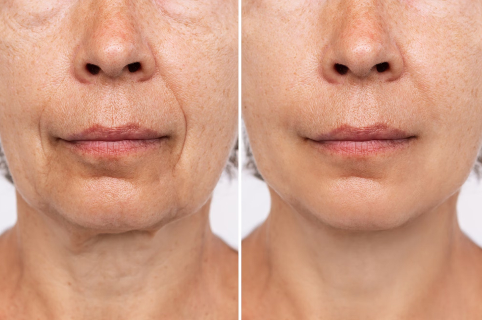 بهترین دکتر تزریق چربی در تهران چه ویژگیهایی دارد؟