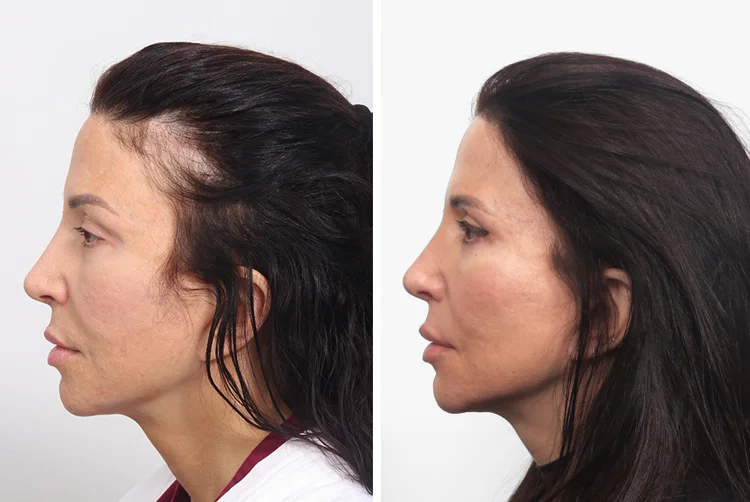 بهترین کلینیک‌های کاشت مو در کرج+ معرفی 10 کلینیک برتر