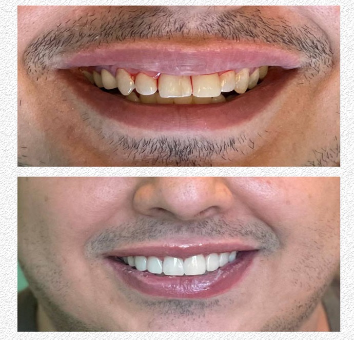 ترمیم دندان‌های شکسته