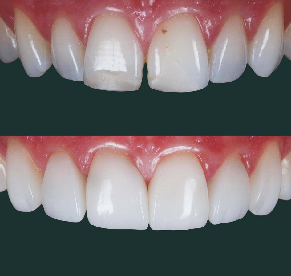 درمان های جانبی مورد نیاز برای کامپوزیت