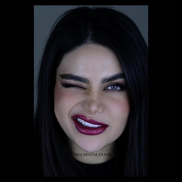 قیمت کامپوزیت دندان در سال 1404 (پرداخت اقساطی هزینه)