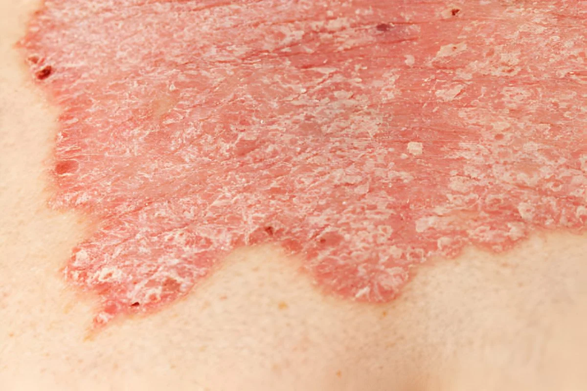 استفاده از سلول های بنیادی در ترمیم زخم