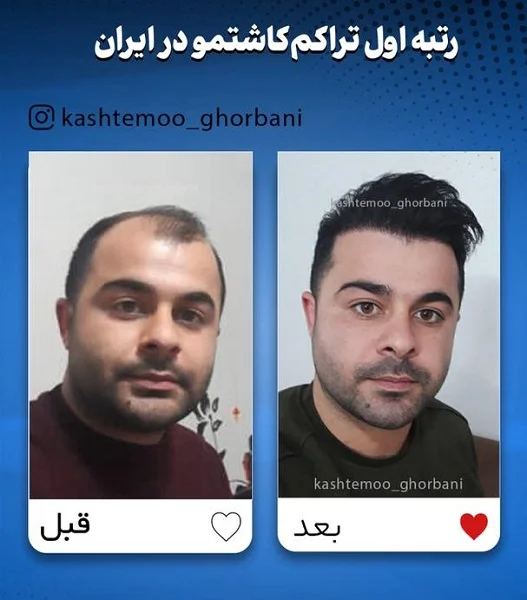 کلینیک کاشت مو مریم قربانی