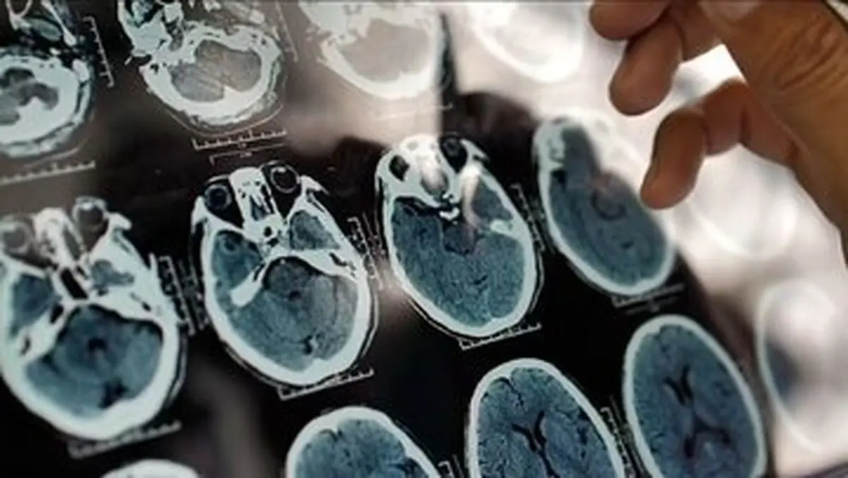 ۵ نشانه هشداردهنده که مغزتان زودتر از سن واقعی پیر می‌شود!