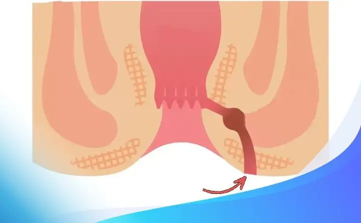 فیستول مقعدی