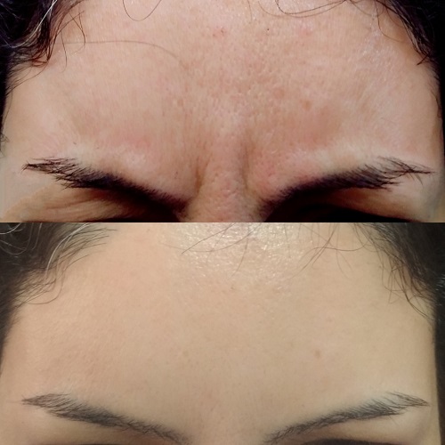 ۸ توصیه برای بوتاکس اولیها